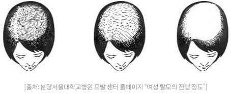 여성 탈모의 진행 정도 [출처:분당서울대학교병원 모발 센터 홈페이지]