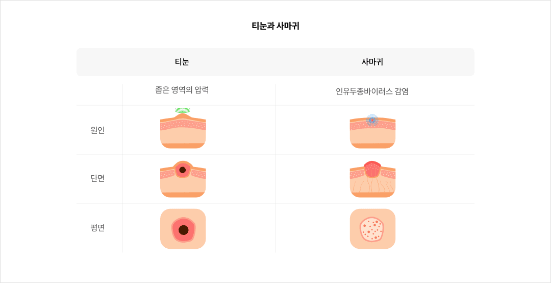 티눈과 사마귀