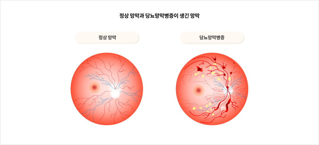 정상 망막과 당뇨망막병증이 생긴 망막