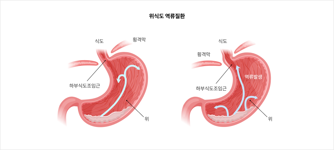 위식도 역류질환