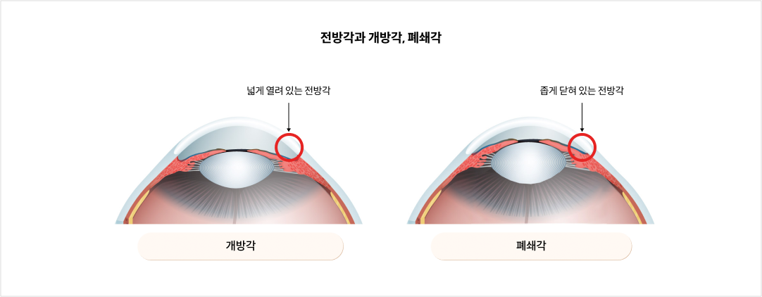 전방각과 개방각, 폐쇄각