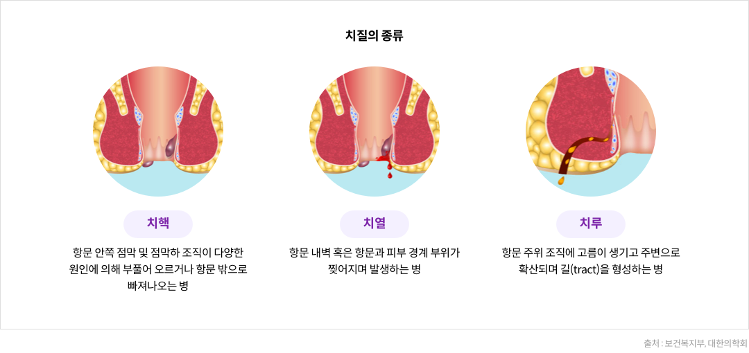 치질의 종류