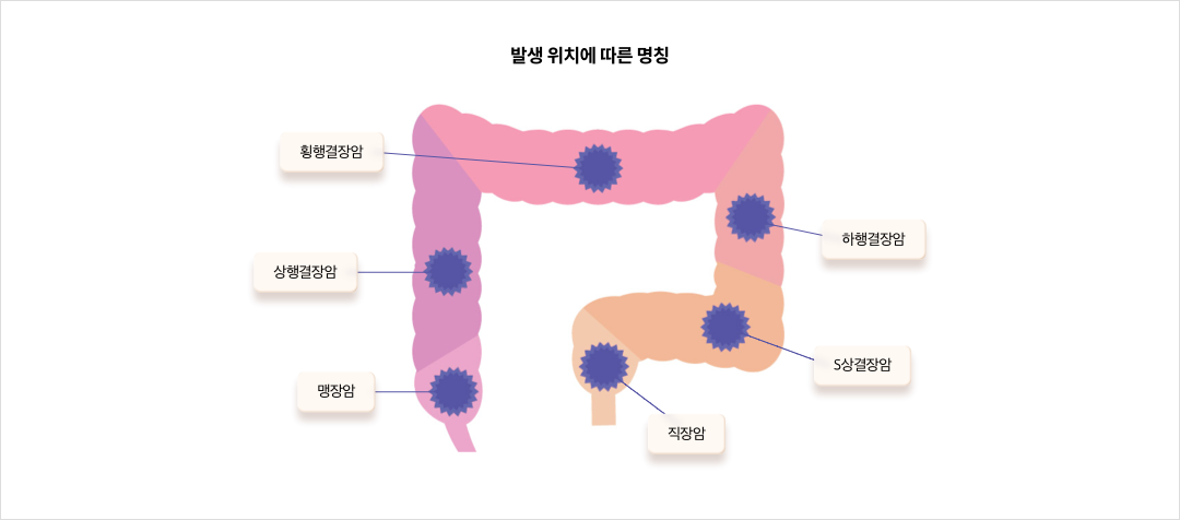 발생 위치에 따른 명칭