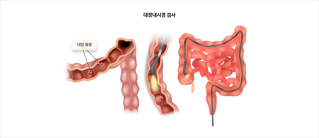 대장내시경 검사