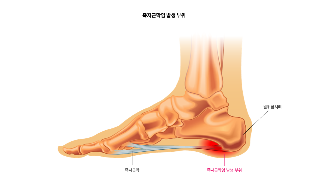 족저근막염 발생 부위