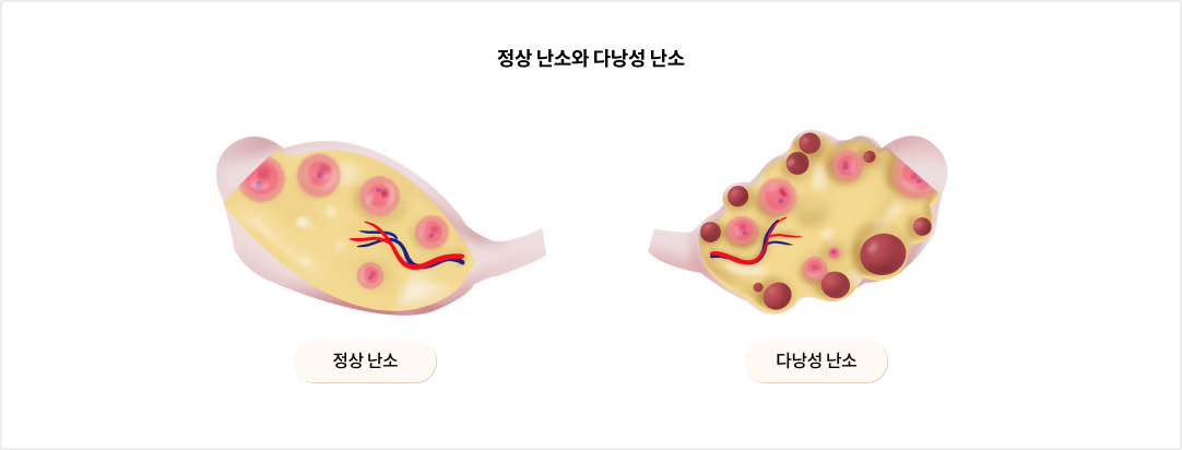 정상 난소와 다낭성 난소