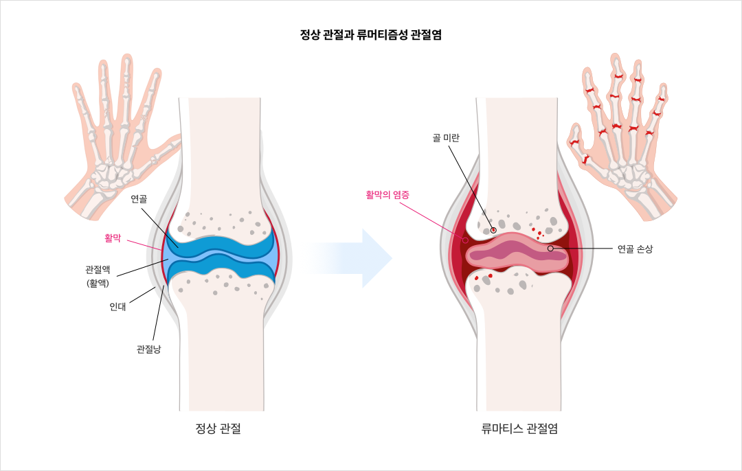 정상 관절과 류머티즘성 관절염