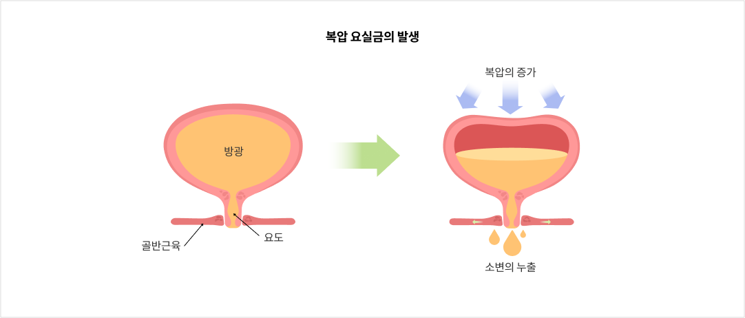 복압 요실금의 발생